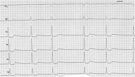 EKG vizsgálat ábrázolása