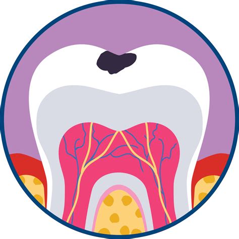 Fogszuvasodás megelőzése terhesség alatt