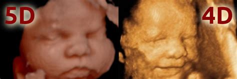 Különbségek a 2D, 3D, 4D és 5D ultrahang között