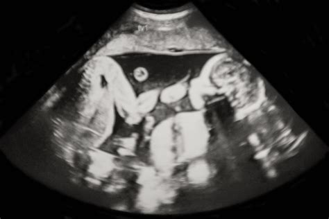 Ultrahangos felvétel ikrekről