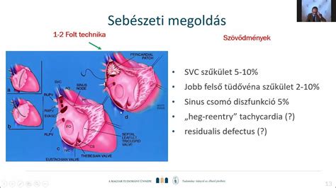 Gyakori veleszületett szívhibák illusztrációja