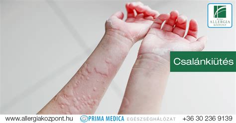 Allergiás bőrkiütések gyermekeknél
