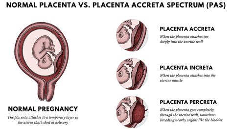 A placenta percreta súlyos következményei