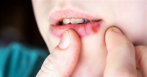 Herpesz kezelése citromfűvel