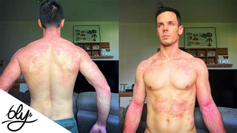 atópiás dermatitis csecsemőn