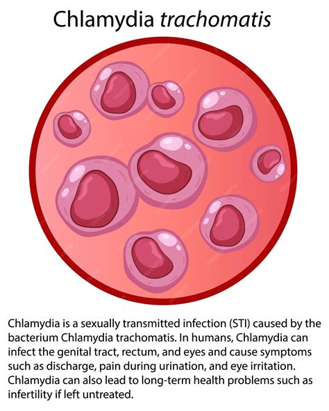 Infografika a Chlamydia szövődményeiről