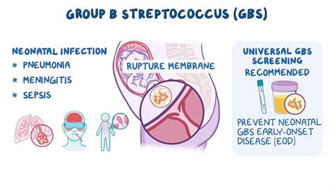 Infografika a B csoportú Streptococcus (GBS) tüneteiről és megelőzéséről.