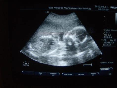 Ultrahangos kép 20 hetes magzatról