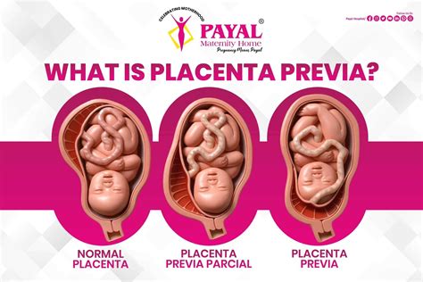 A placenta praevia kockázati tényezői