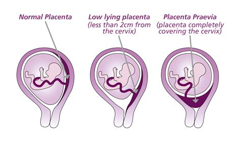 Placenta praevia tünetei