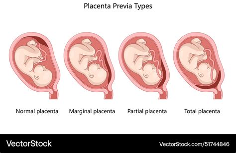 Császármetszés placenta praevia esetén
