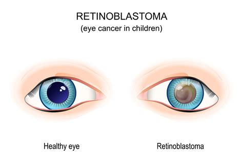 Retinoblastoma tünetei