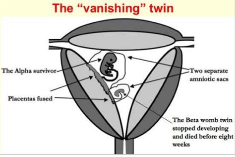Ultrahang kép eltűnő ikerről (vanishing twin)