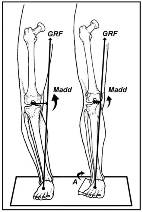 Valgus stressz teszt végrehajtása