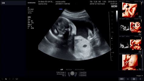 Ultrahangos kép a 30 hetes magzatról