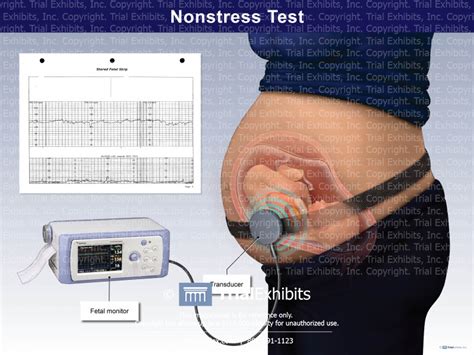Nonstress Test (NST) eljárás