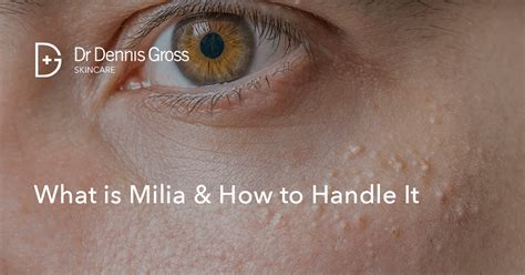 Milia a csecsemő arcán