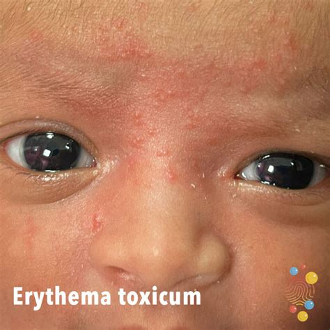 Erythema toxicum neonatorum kiütések