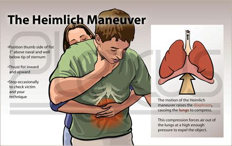 Heimlich-manőver kisgyereknél