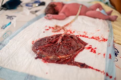 Illusztráció placenta leválásról