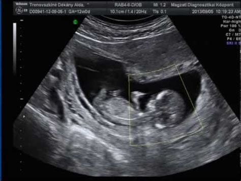 12 hetes magzat ultrahang