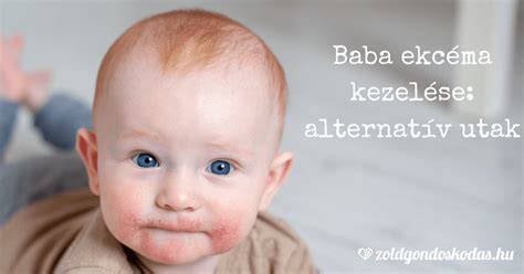 Gyermekkori ekcéma kezelése