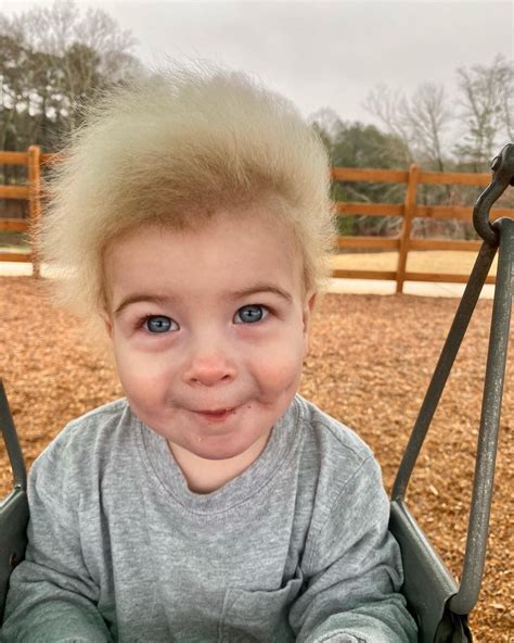Fésülhetetlen haj szindróma mikroszkopikus képe