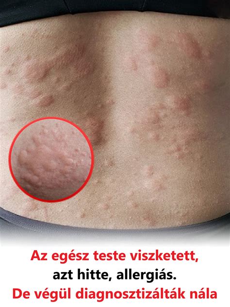 Gyógyszer allergiás reakciók a bőrön