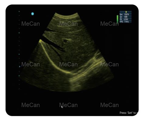 Color Doppler ultrahang kép