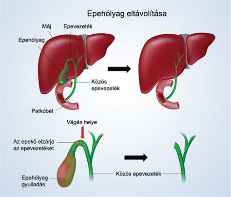 Az epehólyag működése és az epekőképződés