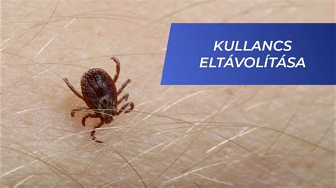 Kullancs eltávolítása lépésről lépésre