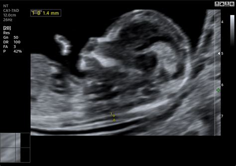 Szív ultrahang kép magzatról