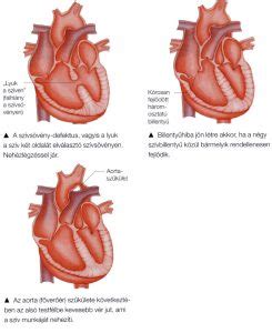 Szív fejlődési rendellenességek statisztika