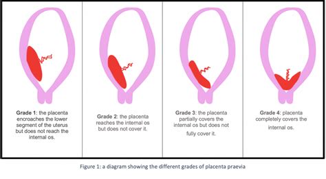 A placenta praevia típusai