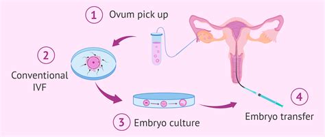 IVF kezelés folyamata