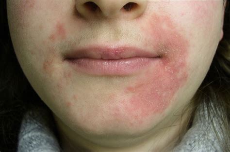 A periorális dermatitisz tünetei a száj körül
