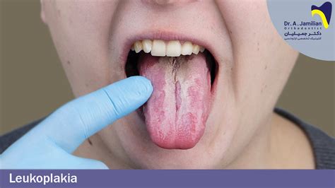 Leukoplakia a nyelven