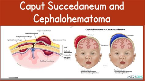 Caput succedaneum és cephalohematoma közötti különbség
