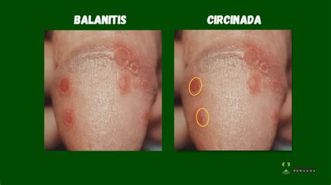 Balanitis tünetei