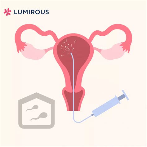 Az intrauterin inszemináció (IUI) lépéseit ábrázoló rajz
