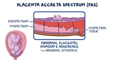 Placenta accreta illusztrációja