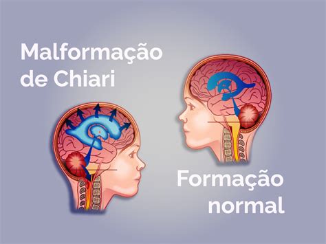 Chiari-malformáció magyarázó ábra