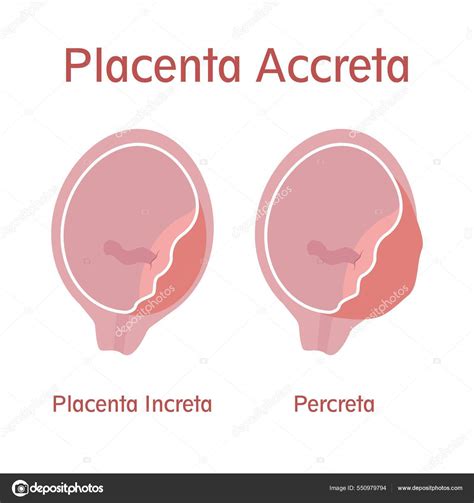 Placenta accreta illusztráció