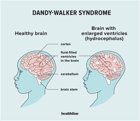Dandy-Walker szindrómás agyi kép MRI-vizsgálaton