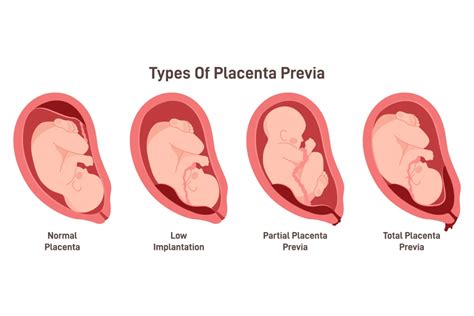 A placenta previa szemléltetése