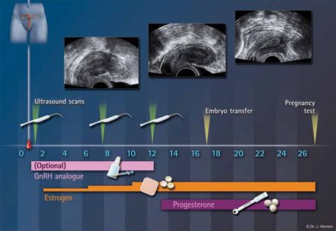 Infografika az embrió beültetésének számáról korcsoportok szerint