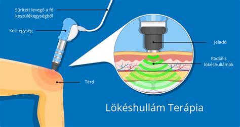 Lökéshullám terápia kezelési folyamata