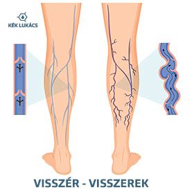 Visszér a lábakon