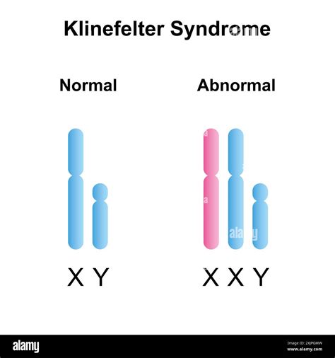 A Klinefelter-szindróma fizikai tüneteinek összefoglaló infografikája
