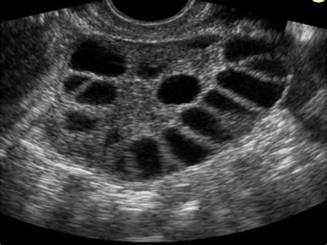 A policisztás petefészek szindróma (PCOS)